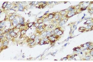 Immunohistochemistry of paraffin-embedded Human liver cancer using ECI2 Polyclonal Antibody at dilution of 1:150 (40x lens). (PECI/ECI2 抗体)