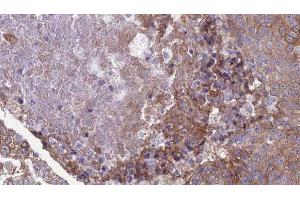 ABIN6276868 at 1/100 staining Human urothelial cancer tissue by IHC-P. (IFNAR2 抗体)
