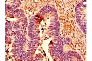 Immunohistochemistry of paraffin-embedded human ovarian cancer using ABIN7150430 at dilution of 1:100