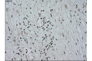 Immunohistochemical staining of paraffin-embedded Carcinoma of kidney tissue using anti-CTAG1Bmouse monoclonal antibody. (CTAG1B 抗体)