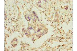 Immunohistochemistry of paraffin-embedded human pancreatic cancer using ABIN7159918 at dilution of 1:100 (TOMM34 抗体  (AA 1-309))