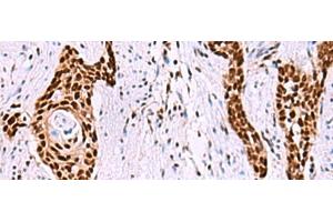 Immunohistochemistry of paraffin-embedded Human esophagus cancer tissue using ISY1-RAB43 Polyclonal Antibody at dilution of 1:55(x200) (ISY1-RAB43 Readthrough (ISY1-RAB43) 抗体)