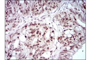 Immunohistochemical analysis of paraffin-embedded rectum cancer tissues using HOXB4 mouse mAb with DAB staining. (HOXB4 抗体  (AA 16-251))