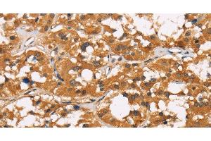 Immunohistochemistry of paraffin-embedded Human thyroid cancer tissue using CD22 Polyclonal Antibody at dilution 1:50 (CD22 抗体)