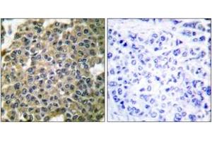 Immunohistochemistry analysis of paraffin-embedded human breast carcinoma tissue, using Keratin 7 Antibody.