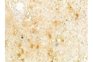 ABIN6261917 and ABIN6278468 at 1/100 staining human astrocytoma by IHC-P.