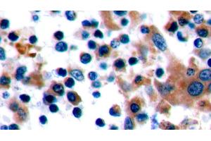 Detection of CTLA4 in Human Tonsil Tissue using Polyclonal Antibody to Cytotoxic T-Lymphocyte Associated Antigen 4 (CTLA4) (CTLA4 抗体  (AA 52-211))