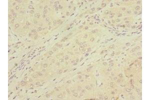 Immunohistochemistry of paraffin-embedded human liver cancer using ABIN7159068 at dilution of 1:100 (MMP19 抗体  (AA 209-508))