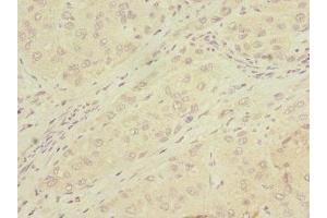 Immunohistochemistry of paraffin-embedded human liver cancer using ABIN7159068 at dilution of 1:100 (MMP19 抗体  (AA 209-508))