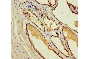 Immunohistochemistry of paraffin-embedded human prostate cancer using ABIN7148974 at dilution of 1:100 (CST11 抗体  (AA 1-138))