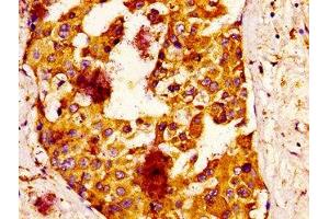 IHC image of ABIN7157026 diluted at 1:100 and staining in paraffin-embedded human breast cancer performed on a Leica BondTM system. (IQCB1 抗体  (AA 445-598))