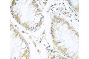 Immunohistochemistry of paraffin-embedded Human gastric cancer using CUL3 Polyclonal Antibody at dilution of 1:100 (40x lens). (Cullin 3 抗体)