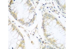 Immunohistochemistry of paraffin-embedded Human gastric cancer using CUL3 Polyclonal Antibody at dilution of 1:100 (40x lens).