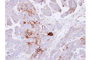 IHC-P Image Immunohistochemical analysis of paraffin-embedded OVCAR3 xenograft , using alkaline phosphatase (liver/bone/kidney), antibody at 1:100 dilution. (ALPL 抗体  (Center))