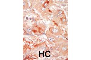 Formalin-fixed and paraffin-embedded human hepatocellular carcinoma tissue reacted with the PRPF4B polyclonal antibody , which was peroxidase-conjugated to the secondary antibody, followed by DAB staining. (PRPF4B 抗体  (C-Term))