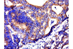 Paraformaldehyde-fixed, paraffin embedded human colon carcinoma, Antigen retrieval by boiling in sodium citrate buffer (pH6. (C21orf62 抗体)