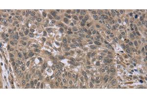 Immunohistochemistry of paraffin-embedded Human lung cancer tissue using IL15RA Polyclonal Antibody at dilution 1:45 (IL15RA 抗体)