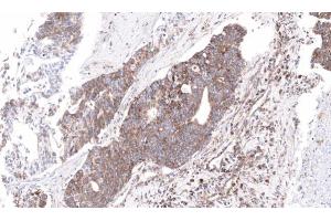 IHC-P Image Immunohistochemical analysis of paraffin-embedded human ovarian cancer, using NDUFS4, antibody at 1:100 dilution. (NDUFS4 抗体  (Center))