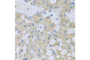 Immunohistochemistry of paraffin-embedded human liver injury using NDUFA7 antibody. (NDUFA7 抗体  (AA 1-113))