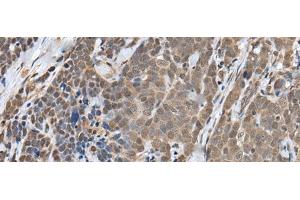 Immunohistochemistry of paraffin-embedded Human thyroid cancer tissue using ZNF410 Polyclonal Antibody at dilution of 1:40(x200) (ZNF410 抗体)