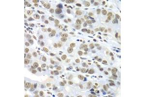 Immunohistochemistry of paraffin-embedded human gastric cancer using HDAC2 antibody. (HDAC2 抗体  (C-Term))