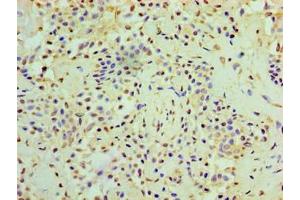 Immunohistochemistry of paraffin-embedded human breast cancer using ABIN7167634 at dilution of 1:100 (RMDN3 抗体  (AA 1-470))