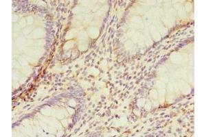 Immunohistochemistry of paraffin-embedded human colon cancer using ABIN7173091 at dilution of 1:100 (TMEM165 抗体  (AA 173-228))