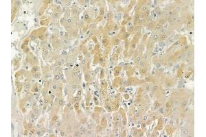 ABIN6258978 and ABIN6276019 at 1/100 staining human hepatocellular carcinoma by IHC-P. (GPR158 抗体  (N-Term))