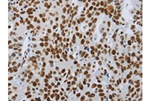 The image on the left is immunohistochemistry of paraffin-embedded Human ovarian cancer tissue using ABIN7192399(SLC16A14 Antibody) at dilution 1/80, on the right is treated with synthetic peptide. (SLC16A14 抗体)
