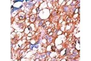 IHC analysis of FFPE human hepatocarcinoma tissue stained with the phospho-ERBB4 antibody. (ERBB4 抗体  (pTyr1162))