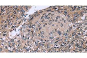 Immunohistochemistry of paraffin-embedded Human cervical cancer using p53RFP Polyclonal Antibody at dilution of 1:50 (RNF144B 抗体)