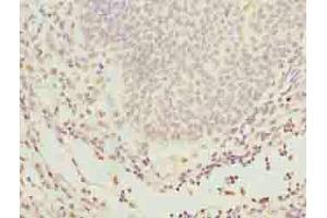Immunohistochemistry of paraffin-embedded human bladder cancer using ABIN7154238 at dilution of 1:100 (GLT1D1 抗体  (AA 17-152))