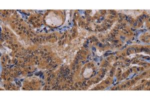 Immunohistochemistry of paraffin-embedded Human thyroid cancer using MCTS1 Polyclonal Antibody at dilution of 1:60
