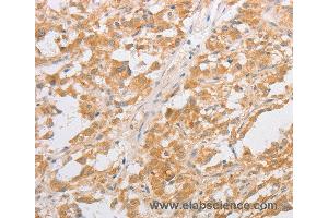 Immunohistochemistry of Human thyroid cancer using CDKN2AIP Polyclonal Antibody at dilution of 1:40 (CDKN2AIP 抗体)