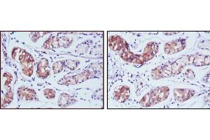 Immunohistochemical analysis of paraffin-embedded human stomach cancer tissues using PGA5 mouse mAb with DAB staining. (PGA5 抗体)