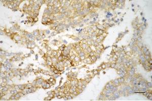 Immunohistochemistry was performed on paraffin-embedded human endometrial carcinoma using SRPK2 antibody (ABIN7800327), 1:200). (SRPK2 抗体)