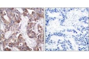 Immunohistochemistry analysis of paraffin-embedded human breast carcinoma, using Stathmin 1 (Phospho-Ser24) Antibody. (Stathmin 1 抗体  (pSer25))