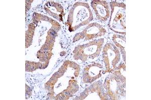 Immunohistochemical analysis of MKK1/2 (pS218/222) staining in human colon cancer formalin fixed paraffin embedded tissue section.