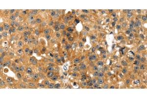 Immunohistochemistry of paraffin-embedded Human breast cancer tissue using SMYD4 Polyclonal Antibody at dilution 1:40 (SMYD4 抗体)