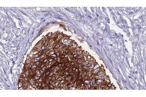 ABIN6276812 at 1/100 staining Human urothelial cancer tissue by IHC-P. (SLC22A5 抗体  (C-Term))