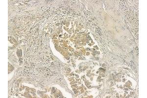 ABIN6258523 and ABIN6274745 at 1/100 staining human lung squamous cell carcinoma by IHC-P. (MRPL51 抗体  (C-Term))