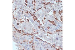Immunohistochemistry of paraffin-embedded human liver cancer using HLA-DRA antibody (ABIN6131757, ABIN6141827, ABIN6141829 and ABIN6215475) at dilution of 1:100 (40x lens). (HLA-DRA 抗体  (AA 26-216))
