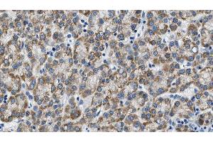 ABIN6274603 at 1/100 staining Human liver cancer tissue by IHC-P. (P-Cadherin 抗体  (N-Term))