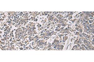 Immunohistochemistry of paraffin-embedded Human colorectal cancer tissue using PRKCSH Polyclonal Antibody at dilution of 1:90(x200) (PRKCSH 抗体)
