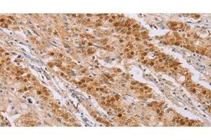 Immunohistochemistry of paraffin-embedded Human gastic cancer using CDC46 Polyclonal Antibody at dilution of 1:40 (MCM5 抗体)