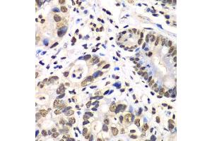 Immunohistochemistry of paraffin-embedded human gastric cancer using RBBP7 antibody. (RBBP7 抗体  (AA 1-230))
