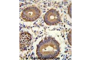 Immunohistochemistry (IHC) image for anti-Carcinoembryonic Antigen Gene Family (CEA) antibody (ABIN3002653) (CEA 抗体)
