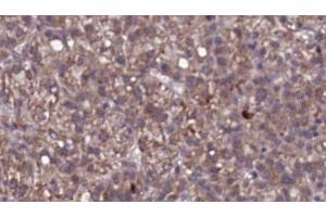 ABIN6276764 at 1/100 staining Human liver cancer tissue by IHC-P. (IL23R 抗体  (N-Term))