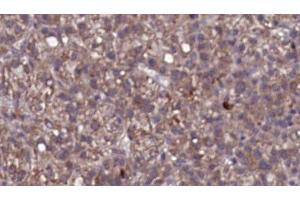 ABIN6276764 at 1/100 staining Human liver cancer tissue by IHC-P. (IL23R 抗体  (N-Term))
