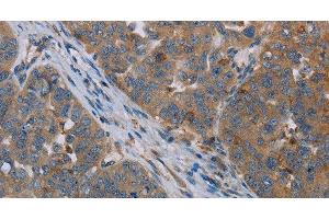 Immunohistochemistry of paraffin-embedded Human ovarian cancer tissue using OTOR Polyclonal Antibody at dilution 1:30 (Otoraplin 抗体)